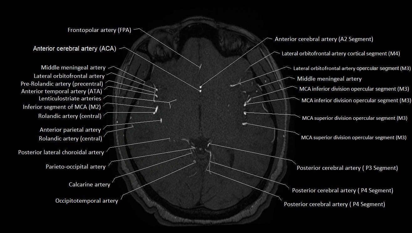 MRA brain (cerebral arteries) anatomy axial 3T image 24.webp